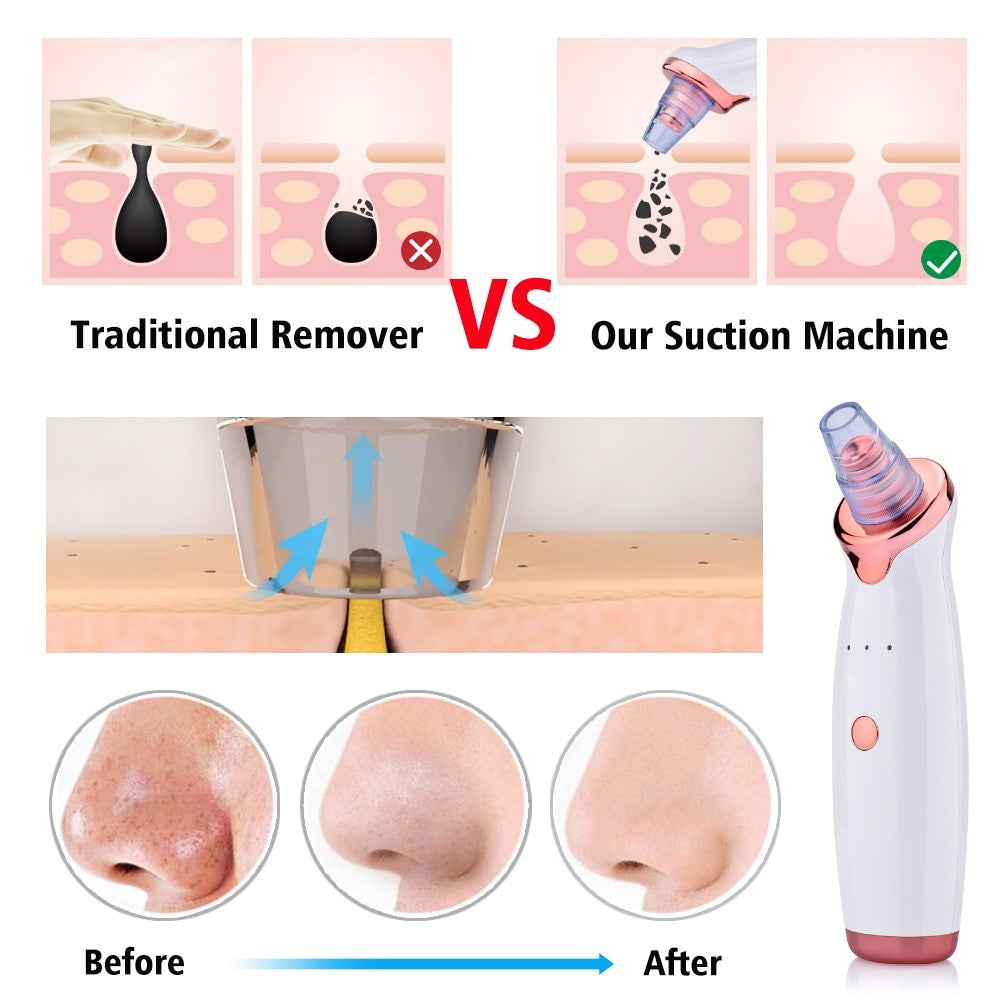 The Microdermabrasion Tool